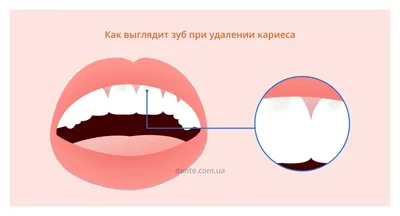 Этапы и методы лечения кариеса зубов в стоматологии в Москве