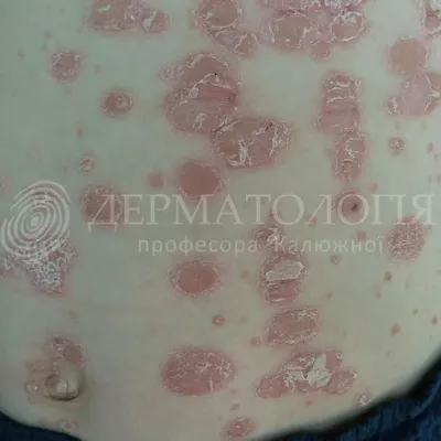 Лечение псориаза (чешуйчатого лишая) в Киеве — Derma.ua