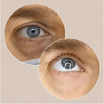 ▻ Как убрать синяк под глазом — советы как лечить синяк под глазом |  Visiobud