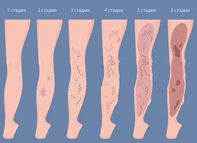 Варикоз: симптомы, стадии, эффективные методы лечения варикозного  расширения вен