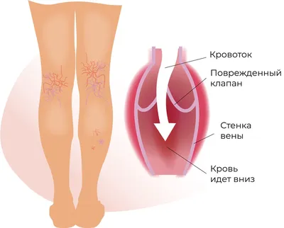 Лечение варикоза в Санкт-Петербурге: лечение варикоза на ногах по низкой  цене в \"МедЛайн\"