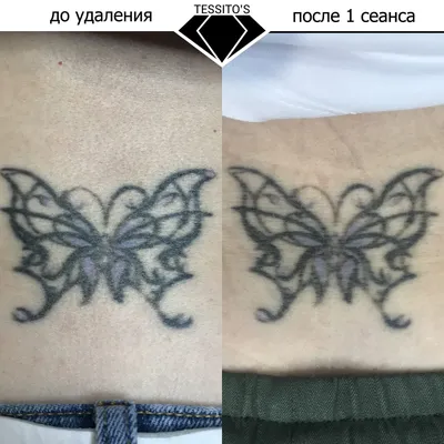 Удаление татуировок лазером - «Лазерное удаление тату. Как, зачем и почему?  Обновление 15.02.2018» | отзывы