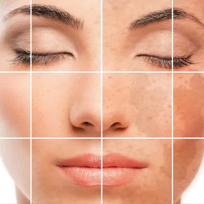 Гиперпигментация кожи лица и тела — что это, причины, виды, лечение