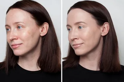 Пигментные пятна: как убрать, лучшие советы визажистов по маскировке |  Beauty Insider