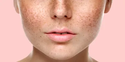 Пигментные пятна на лице: как их убрать, причины появления и методы лечения