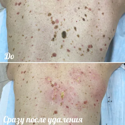 Актинический кератоз — Derma.ua