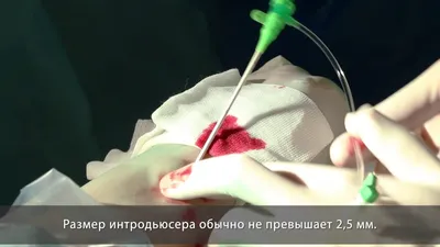 Стентирование коронарных артерий в Екатеринбурге - Новая Больница