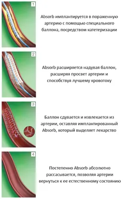 Стентирование сосудов сердца коронарное в Минске - сколько стоит