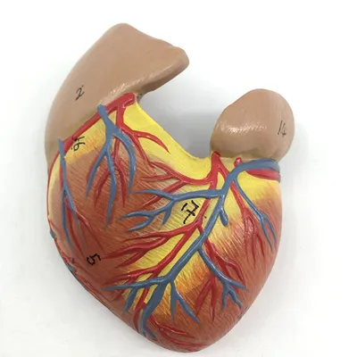 Стентирование коронарных артерий при хронической ишемической болезни сердца