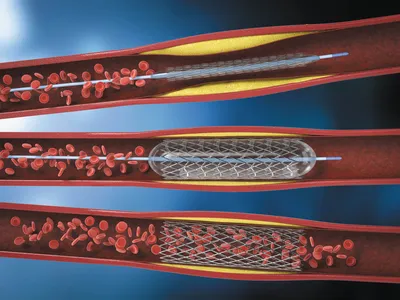 Стентирование | Эндоваскулярная хирургия в Минске