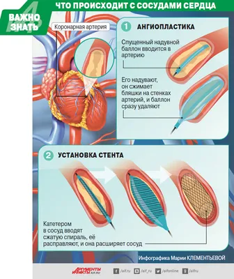 Биорассасывающийся стент последнего поколения | Herzliya Medical Center |  Treatment in Israel