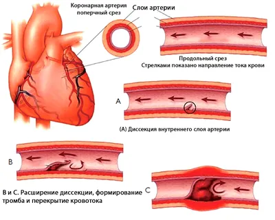 ТОО \"Костанайский областной кардиологический центр\" - Сосуды, питающие  сердце кровью, со временем покрываются изнутри отложениями и сужают просвет  артерии, в последствии чего приток крови к сердцу сокращается и развивается  ИБС. В этом