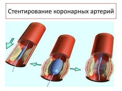 Стентирование сосудов сердца: коронарное стентирование в Одессе|  Медицинский дом Odrex