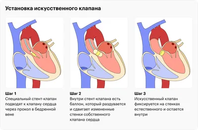 Стентирование - виды, прогнозы, замена