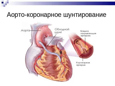 Биорастворимые стенты для лечения ишемической болезни сердца | ООО  «Медсервис» - лидер медицины Башкортостана!