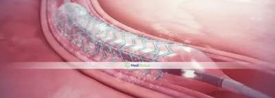 Баллонная ангиопластика и стентирование сонной артерии