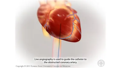 Стентирование коронарных артерий при хронической ишемической болезни сердца