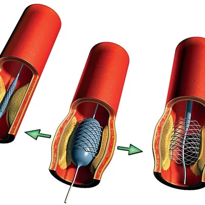 Dr. Ivaniuk - Удивительно, но нашу жизнь может спасти небольшое медицинское  устройство длиной от 8 до 38 миллиметров, а диаметром от 2,25 до 6  миллиметров. Я говорю о медицинском стенте. 💟Стент представляет