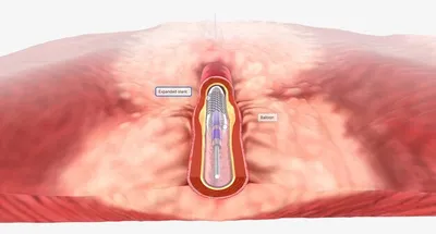 Stent Angioplasty On Scientific Background. 3d Illustration Фотография,  картинки, изображения и сток-фотография без роялти. Image 188675299