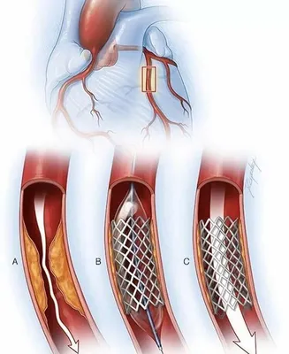 Стентирование коронарных артерий - YouTube