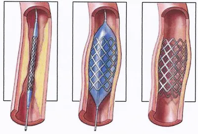 Стентирование при ишемической болезни сердца