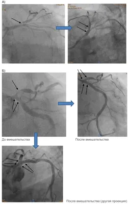 Ангиопластика и стентирование коронарных артерий сердца | ООО «Медсервис» -  лидер медицины Башкортостана!