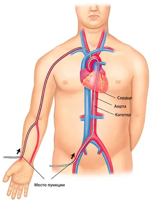 Ангиопластика и стентирование коронарных артерий