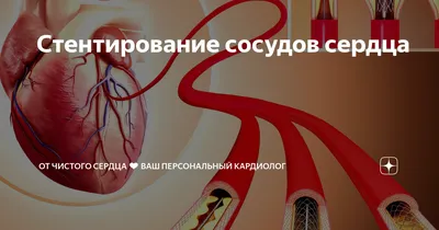 Ангиопластика и стентирование коронарных артерий - Инновационный сосудистый  центр - ИСЦ