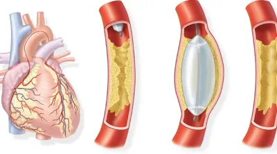 Стентирование коронарных артерий в Екатеринбурге - Новая Больница