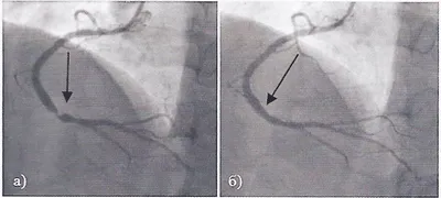 Можно ли делать МРТ после стентирования сосудов сердца