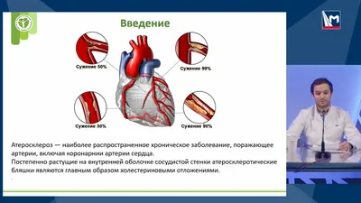 Результаты стентирования ствола левой коронарной артерии у больных со  стабильной формой ишемической болезни сердца с использованием стентов с  биодеградируемым и постоянным полимерами – тема научной статьи по  клинической медицине читайте бесплатно текст