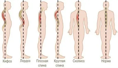 Сколиоз: виды, причины и лечение в Херсоне | Neuro.ks.ua.