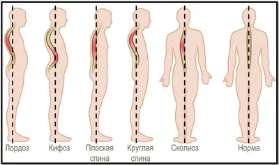 S-Образный сколиоз 1-2-3 степени, причины, лечение грудо-поясничного отдела  позвоночника