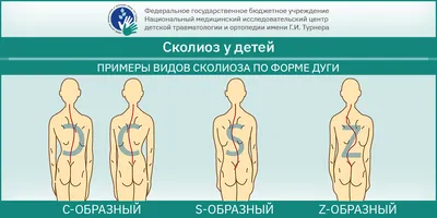 Сколиоз - лечение, симптомы, диагностика, причины, коррекция спины