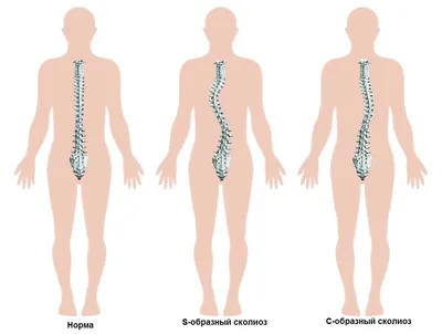 Степени сколиоза и их лечение в Москве | Отделение детской костной  патологии и ортопедии ЦИТО