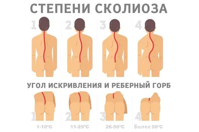 Какие бывают степени сколиоза - Доктор Позвонков