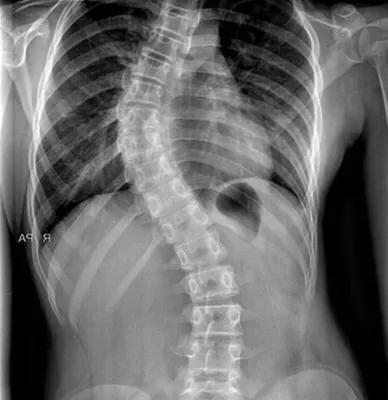 Сколиоз позвоночника 1,2,3,4 степени - лечение, симптомы, причины