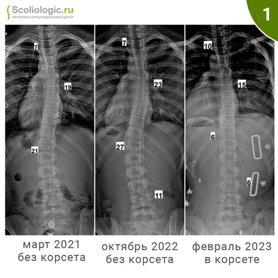 Идиопатический правосторонний сколиоз 2-3 и 4 степени - операция в клинике  лечения позвоночника SL-Клиника