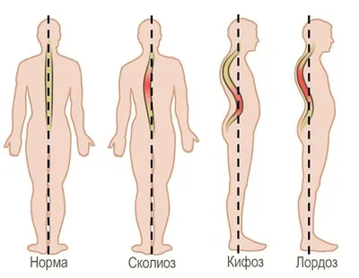 S-образный сколиоз позвоночника: степени и лечение, как исправить S- и  С-образное искривление позвоночника | Клиника Temed
