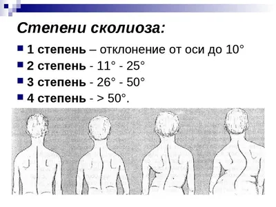 Сколиоз (искривление позвоночника) — лечение в Ростове-на-Дону | Цены и  отзывы