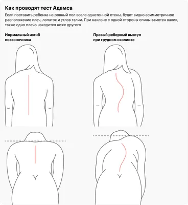 Лечение сколиоза II степени | Протезно-ортопедический центр | Дзен