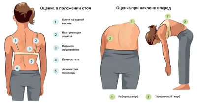 Лечение сколиоза позвоночника - Неврологический центр в Казани – клиника  «Хорошие Руки»