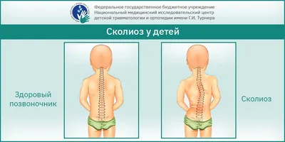 Сколиоз 1 степени: разновидности, лечение и особенности у детей