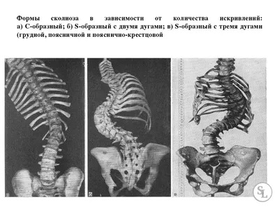 Лечение сколиоза в санатории. Профилактика искривления позвоночника в  санатории Архипо-Осиповка