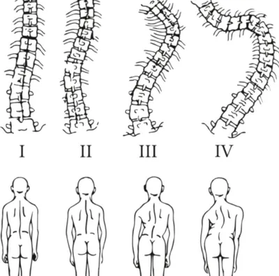 Сколиоз: этиология, классификация, диагностика, лечение - Vertebra