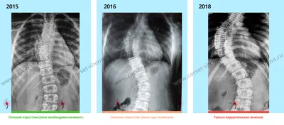 Сколиоз у детей — причины, виды, правильная диагностика сколиоза у ребенка  - Национальный медицинский исследовательский центр детской травматологии и  ортопедии имени Г. И. Турнера - официальный сайт