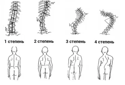 S-Образный сколиоз 1-2-3 степени, причины, лечение грудо-поясничного отдела  позвоночника