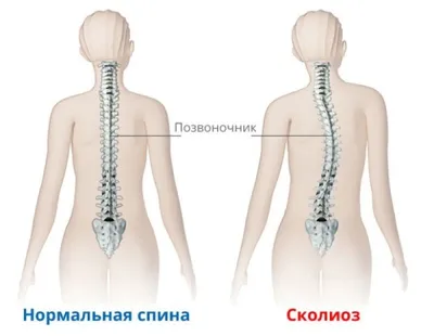 Лечение сколиоза позвоночника в Кургане.