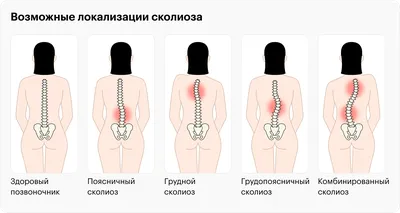 БЕРУТ ЛИ В АРМИЮ СО СКОЛИОЗОМ? — Юлия Куршакова на TenChat.ru