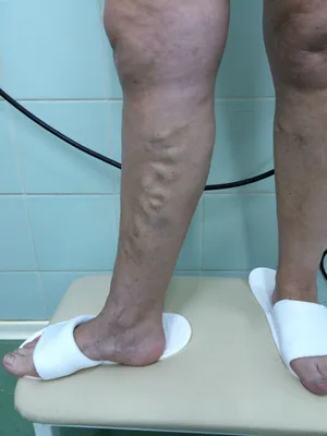 Современные методы лечения варикозного расширения вен ног | Рязань
